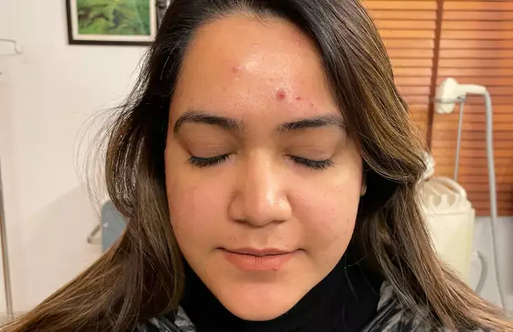 acne-treatment