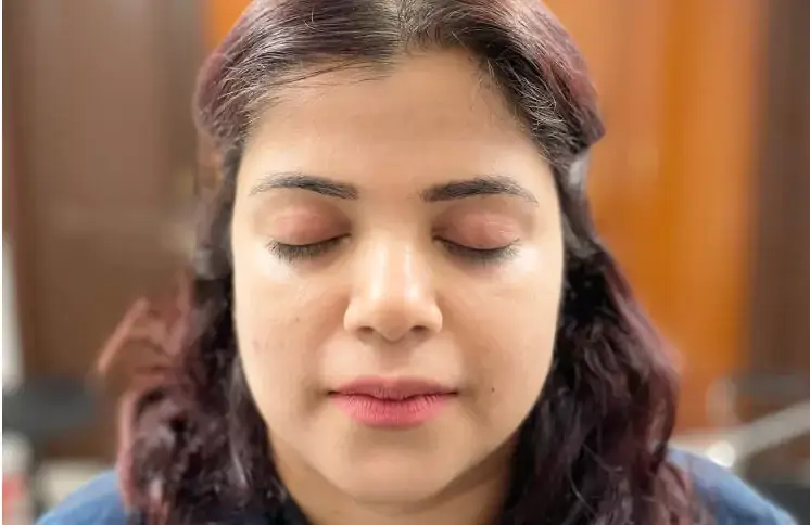 chemical-peel