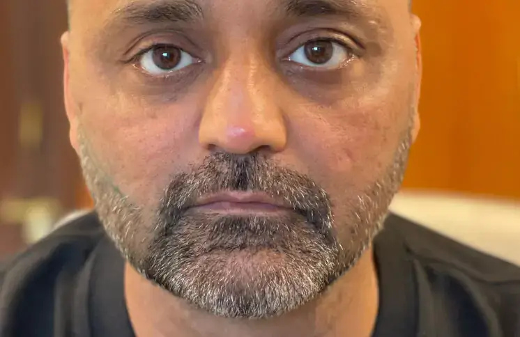 threadlift-face