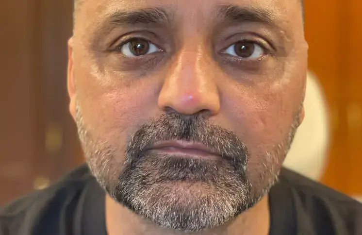 threadlift-face