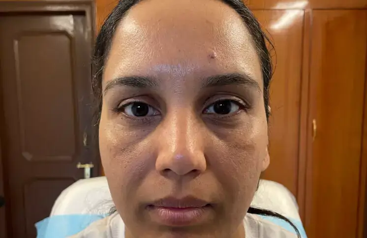 under-eye