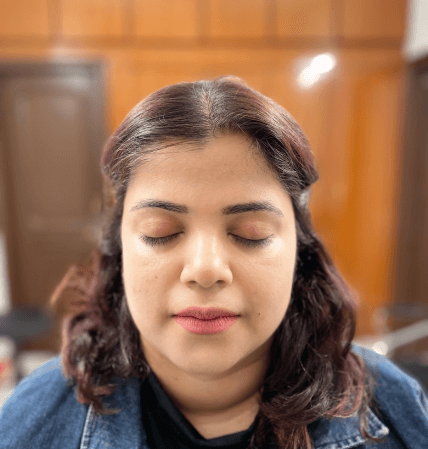 chemical peel