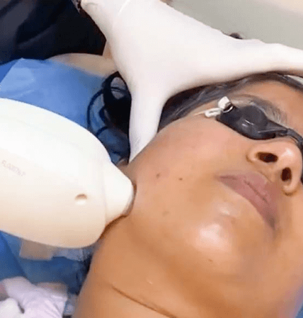 laser hair removal